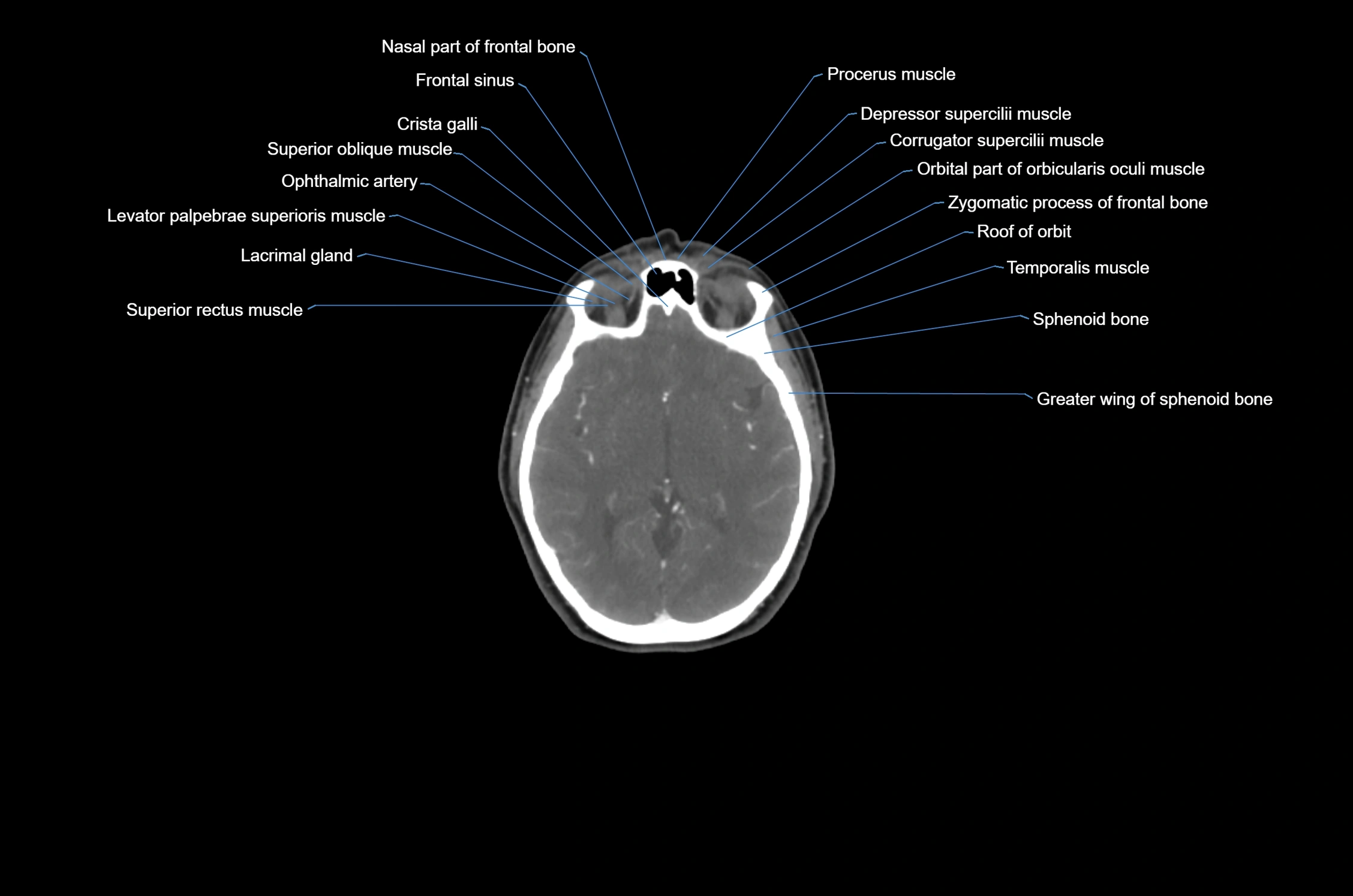 CT Neck axial cross sectional anatomy radiology image-img-00001-00002.webp